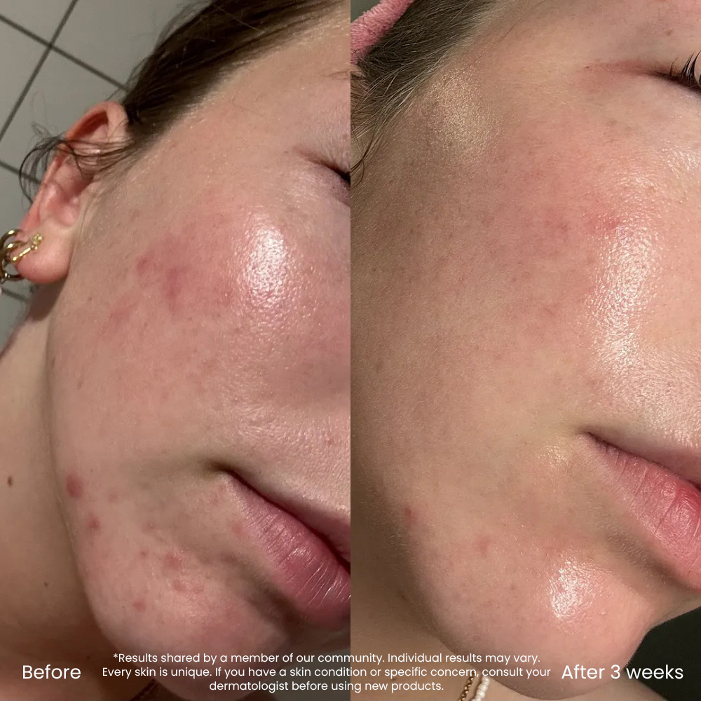 Hyaluronic Acid Set For Dry Skin & Natural Glow