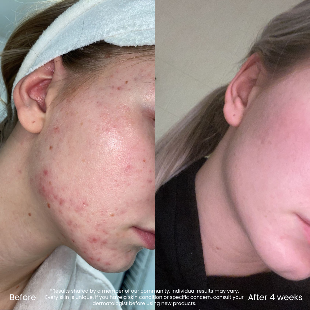 Triple AHA Clarifying Cleanser For Blemishes & Clear Skin