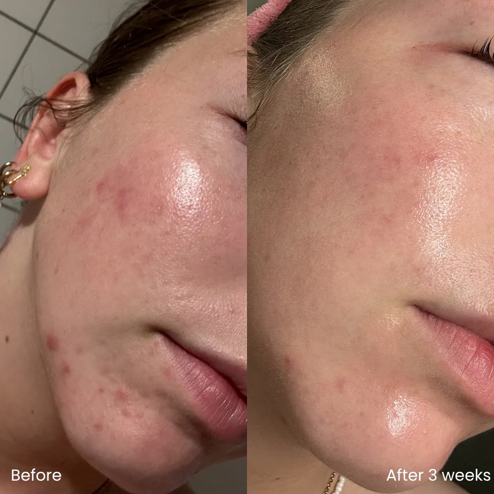 Hyaluronic acid set