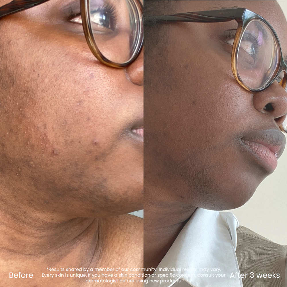0.3% Retinol Serum For Fine Lines & Uneven Texture