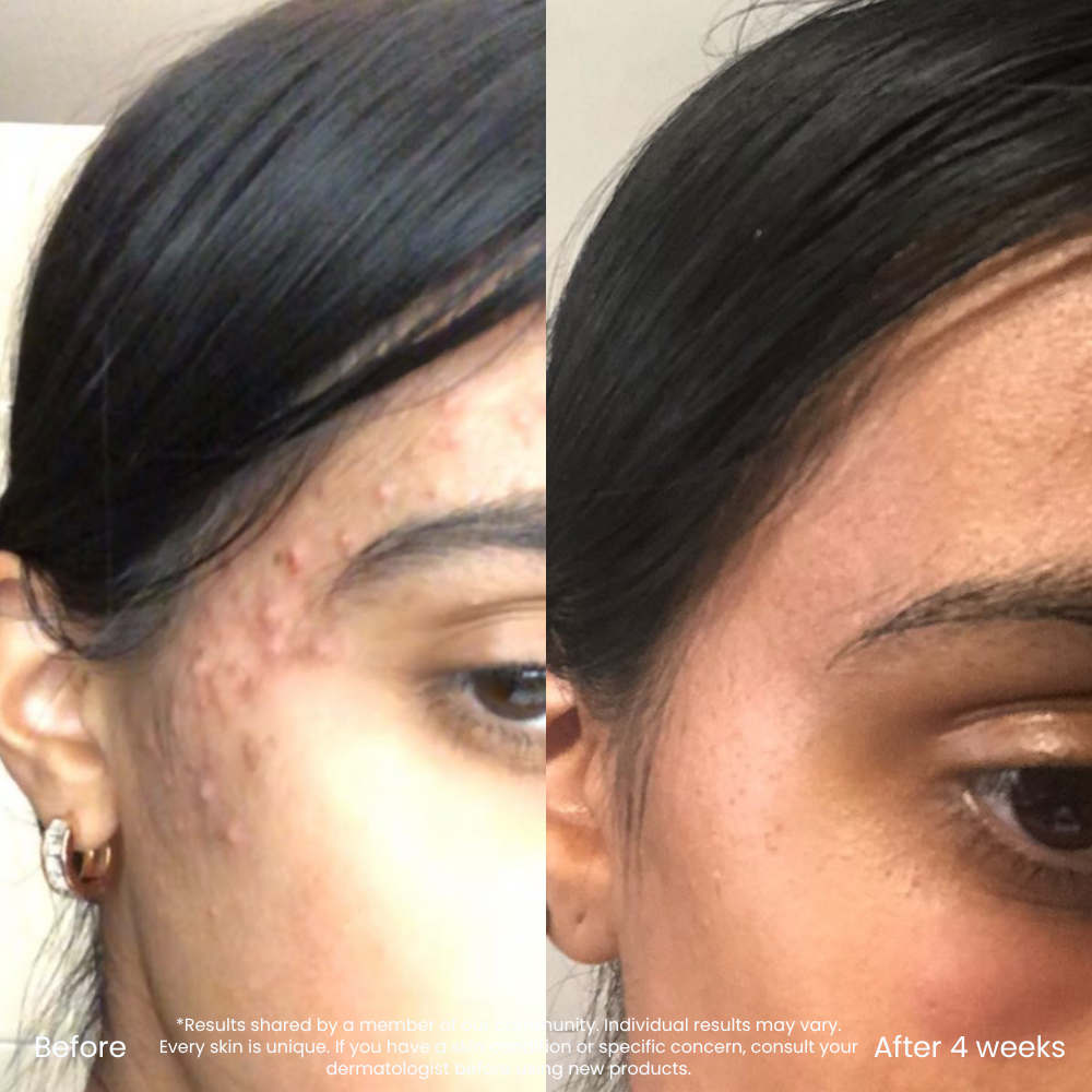 Triple AHA Clarifying Cleanser For Blemishes & Clear Skin